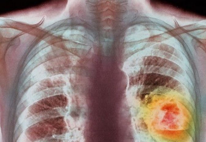 Bulgaria şi România, cea mai mică pondere a deceselor provocate de cancer din Uniunea Europeană