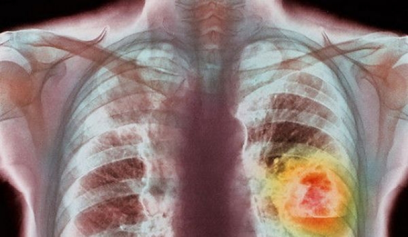 Bulgaria şi România, cea mai mică pondere a deceselor provocate de cancer din Uniunea Europeană