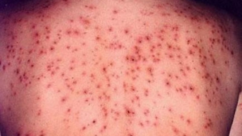 Alte 23 de cazuri de rujeolă au fost confirmate. Numărul  îmbolnăvirilor a ajuns la peste 15.000 iar 59 de persoane au murit