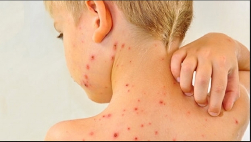 Atenție, RUJEOLA revine în forță, în unele județe din țară - Zeci de cazuri în doar o săptămână