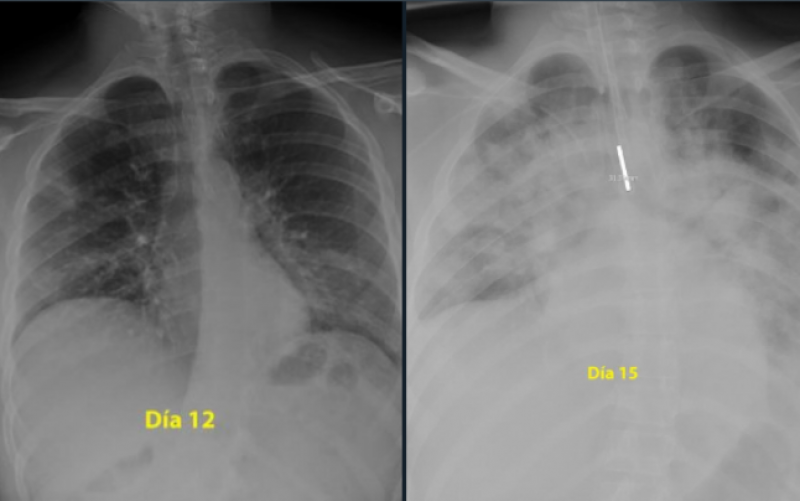 Medicii avertizează că şi tinerii sunt afectaţi grav de COVID-19. Virusul a suferit până acum 10 mutaţii
